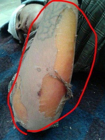 ISIS used chemical weapon against Kurdish fighters ISIS used chemical weapon against Kurdish fighters