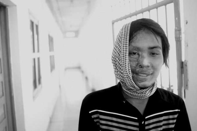 9 women injured in acid attack in Pb