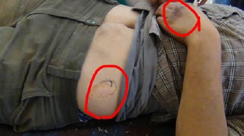 ISIS used chemical weapon against Kurdish fighters ISIS used chemical weapon against Kurdish fighters