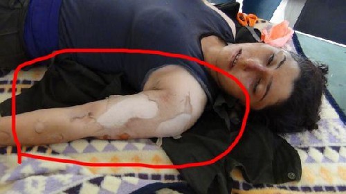 ISIS used chemical weapon against Kurdish fighters ISIS used chemical weapon against Kurdish fighters