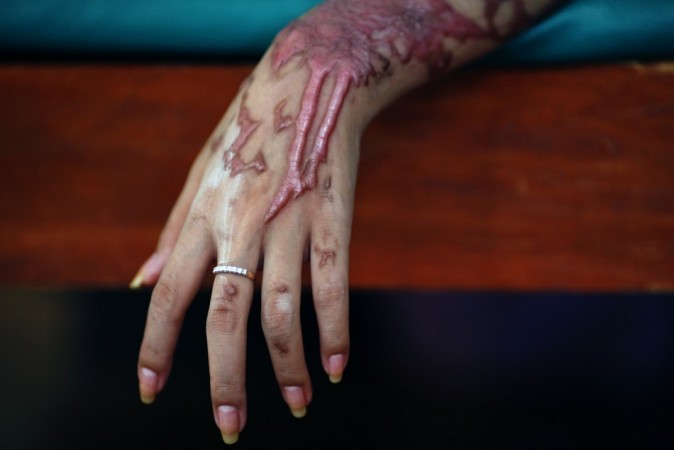 Acid Attack Victimhttp://graphic1.ibtimes.co.in/www/img/adm/closebt.png