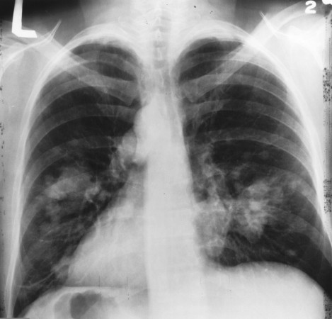 Growth shown on the left side of the lung 肺癌