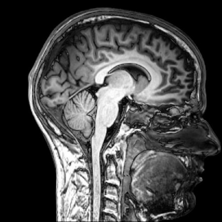 brain scan