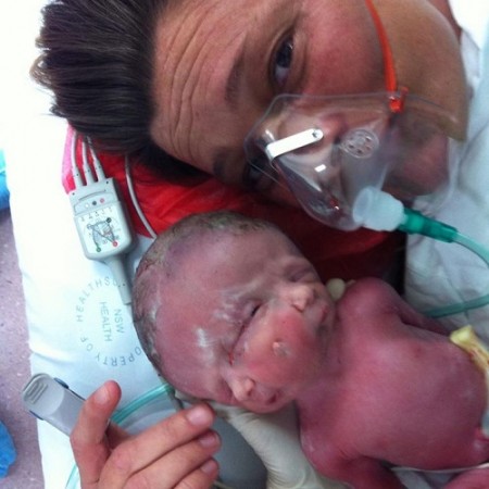 Renee Young with her conjoined twins Hope & Faith Renee Young with her conjoined twins