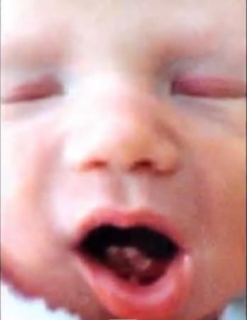 Baby Rose's fully grown two front teeth Baby Girl Born With Two Front Teeth