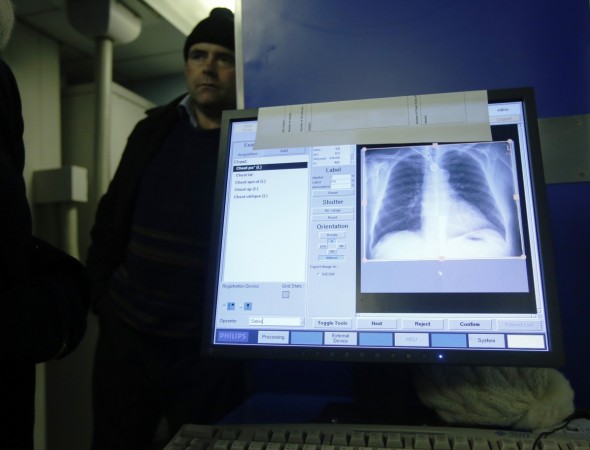 tuberculosis