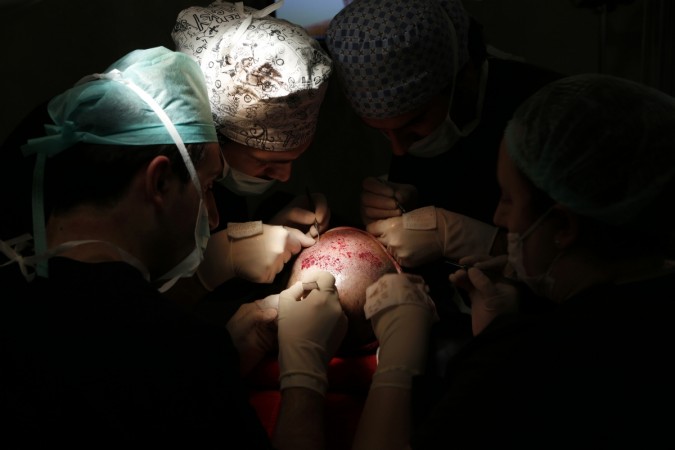 hair transplant