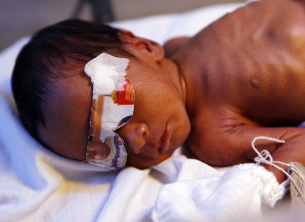 A Cardboard Mask Covers The Eyes Of A Newly Born Baby Afflicted With Jaundice In A Government Run Fabella Maternity Hospital In Manila A Day Before World A Cardboard Mask Covers The Eyes Of A Newly Born Baby Afflicted With Jaundice In A Government Run Fabella Maternity Hospital In Manila A Day Before World