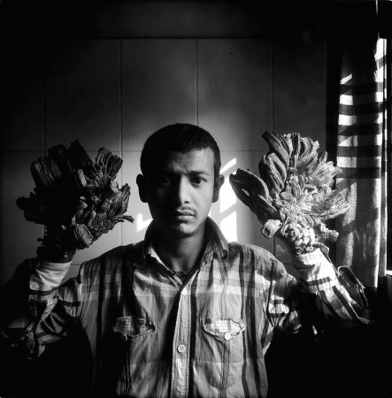 Abul Bajandar from Dhaka, Bangladesh is the fourth man in the world with the tree man illness, a rare skin disorder caused by a virus named human papillomaviruses. He got treated now. tree man illness, health, disease,