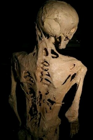 The effects of Fibrodysplasia ossificans progressiva (FOP), a disease which causes damaged soft tissue to regrow as a bone. rare disorder, genetic,