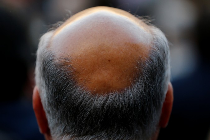 A man with baldness is seen in Seville, southern Spain April 6, 2016. A man with baldness is seen in Seville, southern Spain April 6, 2016.