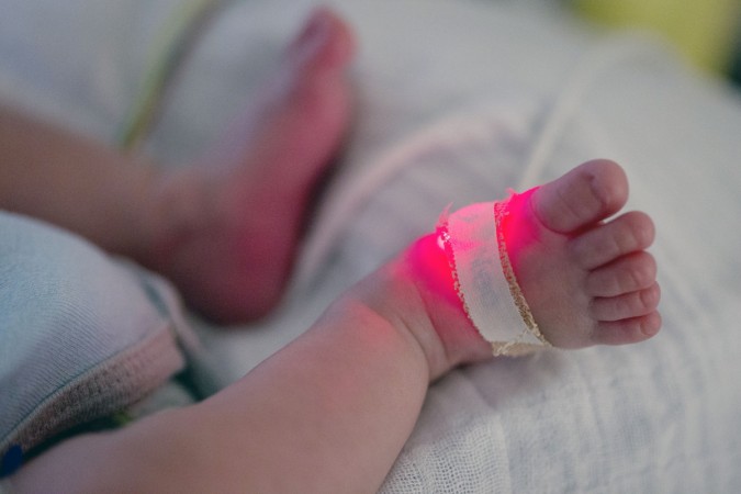 The infant was branded with a hot iron to cure her fever and cold. (Representational image) baby feet, baby toes