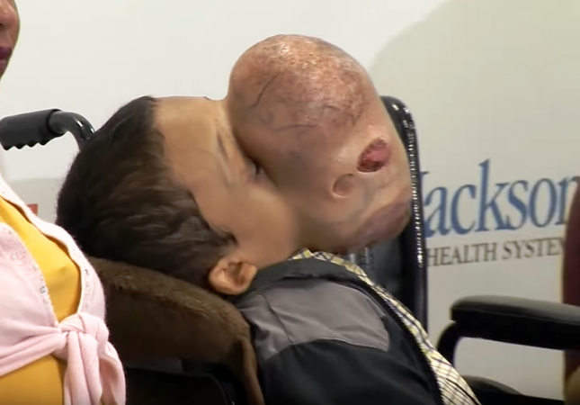 Emanuel's vision is blocked, allowing him only able to look up and sideways. Also fractures and curvature to his arm and leg caused by his condition, leave him unable to walk. emanuel tumour