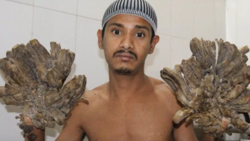 Abul Bajandar, 27, underwent multiple surgeries to remove the 11lb growth on his hands that had left him unable to even hold his daughter. The rickshaw driver's condition is known as epidermodysplasia verruciformis (EV). tree man
