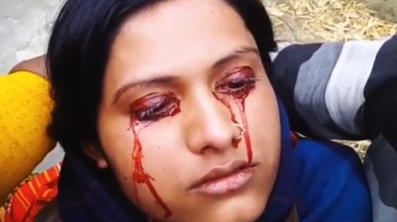 Geeta, from Bihar, India, suffers from a rare medical condition called hematohidrosis - which causes blood to come out of her tear and sweat glands. woman sweats blood