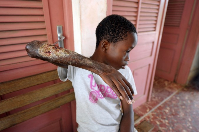 A young boy shows his arm skin damaged by Buruli ulcer. Buruli ulcer, flesh eating bacteria
