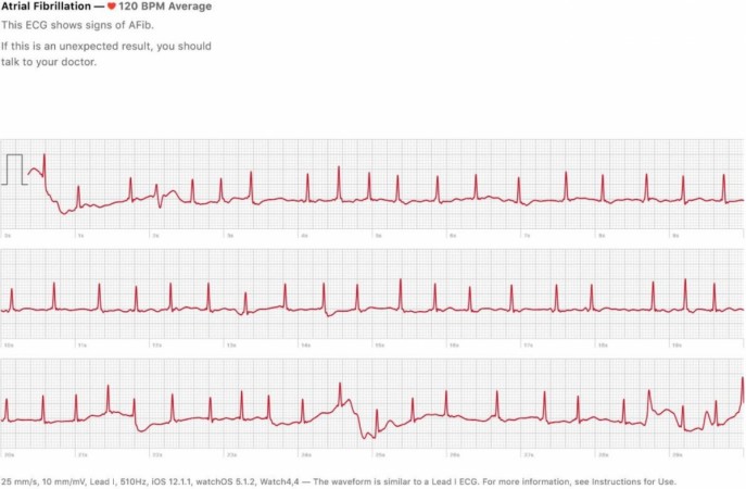 Apple Watch Series 4 ECG app detects AFib in its owner in US. Apple, Watch Series 4, ECG, AFib, reading,