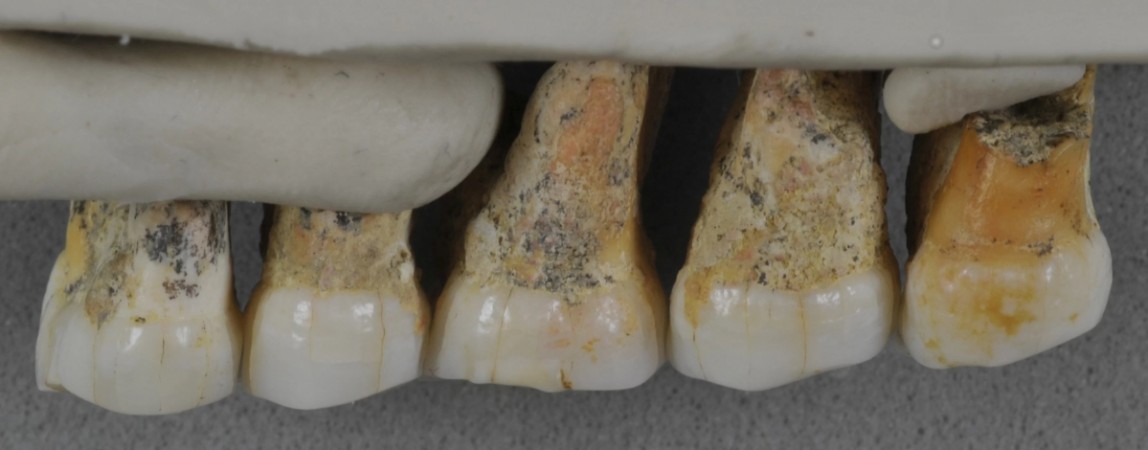 The teeth bones recovered from Callao Caves of the Philippines island of Luzon display characteristics of early humans as well as modern humans. From left: Two premolars and three molars. Teeth of hobbit-like dwarf humans Homo luzonensis