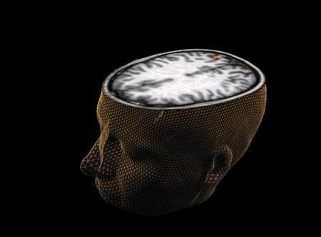 Brain changes linked with conduct disorder