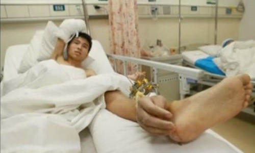 Xie Wei with hand attached to his ankle (YouTube Screenshot/Reuters) Chinese man with hand attached to ankle