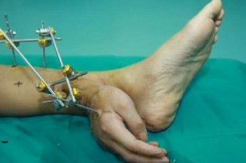 Hand grafted to ankle (YouTube Screenshot/Reuters) Hand grafted to ankle
