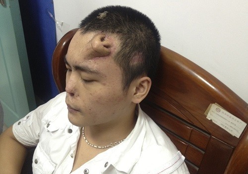 A new nose, grown by surgeons on Xiaolian's forehead, is pictured before being transplanted to replace the original nose, which is infected and deformed, at a hospital in Fuzhou. (Reuters) A new nose, grown by surgeons on Xiaolian's forehead, is pictured before being transplanted to replace the original nose, which is infected and deformed, at a hospital in Fuzhou. (Reuters)
