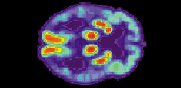 Researchers found two drugs that could slow down the progression of neurodegenerative diseases like Alzheimer's and Parkinson's. drugs, Neurodegenerative brain disorders, Alzheimer's, Parkinson's,