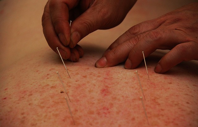 acupuncture