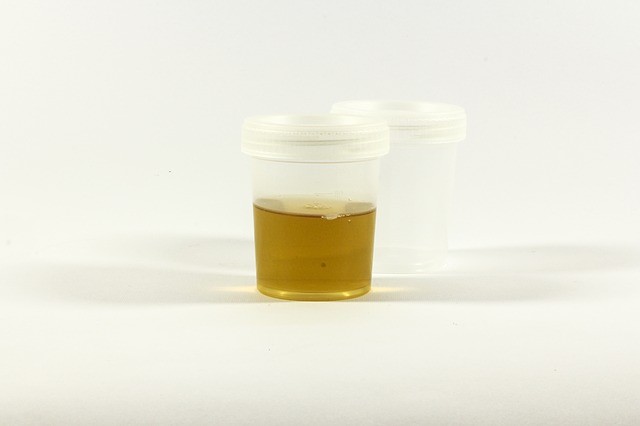 Representational image of a urine sample. Urine test