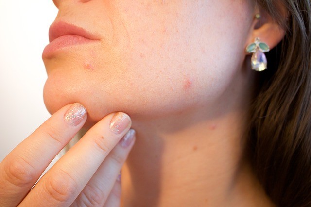 Representational picture of acne. acne