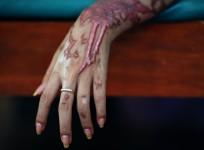 Acid Attack Victimhttp://graphic1.ibtimes.co.in/www/img/adm/closebt.png