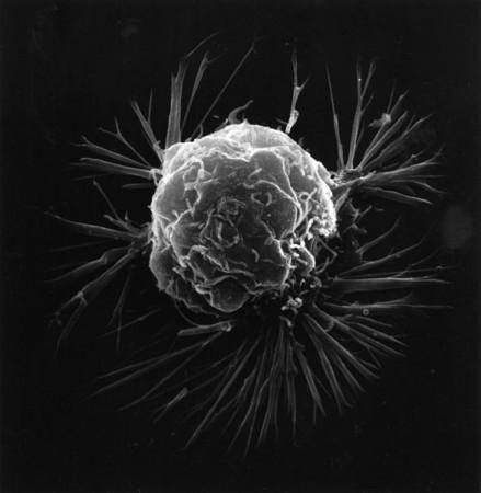 Breast cancer cell (Wiki Commons)