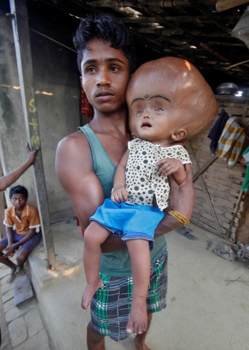 Roona Begum's Giant Head Reduced to 23 Inches; Starts Smiling, Crawling