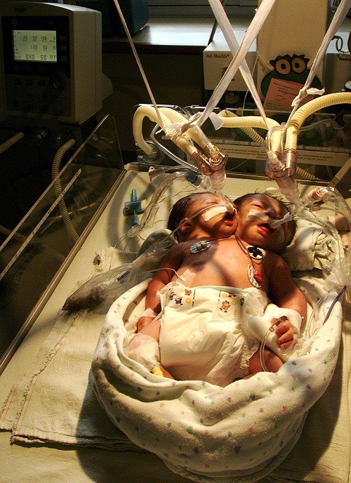 conjoined baby girls