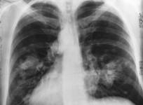 Lung cancer