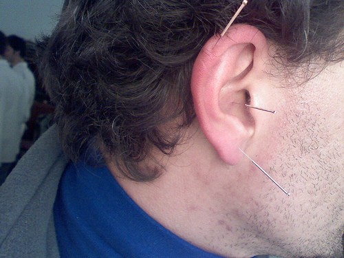 Ear Acupuncture