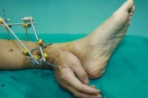 Hand grafted to ankle (YouTube Screenshot/Reuters) Hand grafted to ankle