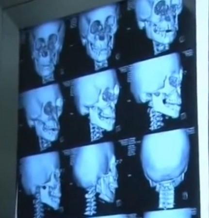 Surgeons Reconstruction The Face of Bowen,that was crushed in an accident. China Boy With Batman's Titanium Mask Inside His Face