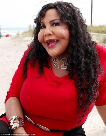 Plastic Surgery Earns Woman the Nickname 'Cement Face’