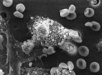 prostate-cancer-wikimedia-commons