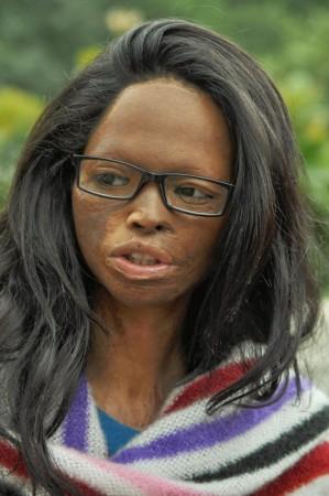 A victim of acid attack