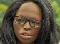 a-victim-of-acid-attack
