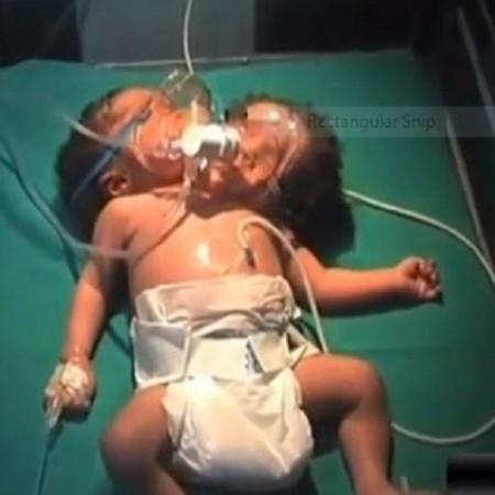 Baby with two heads