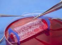 lab-grown-vaginal-organ-successfully-implanted-on-four-women-reuters