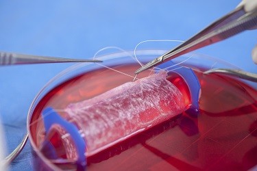 Lab-Grown Vaginal Organ Successfully Implanted on Four Women (Reuters)
