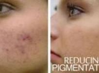 reducing-skin-pigmentation