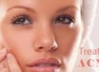 treating-acne