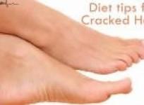 diet-tips-for-cracked-heels