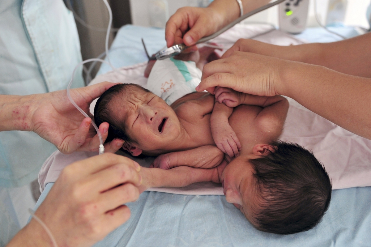 mother-s-day-special-rare-mono-mono-twins-born-holding-hands-in-ohio