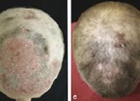 Hair growth